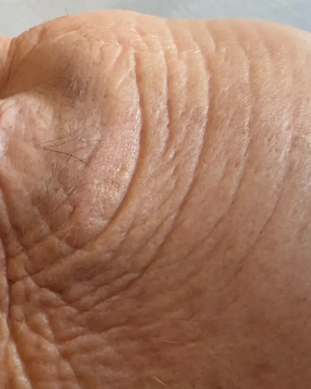 Prima: Rughe del contorno occhi