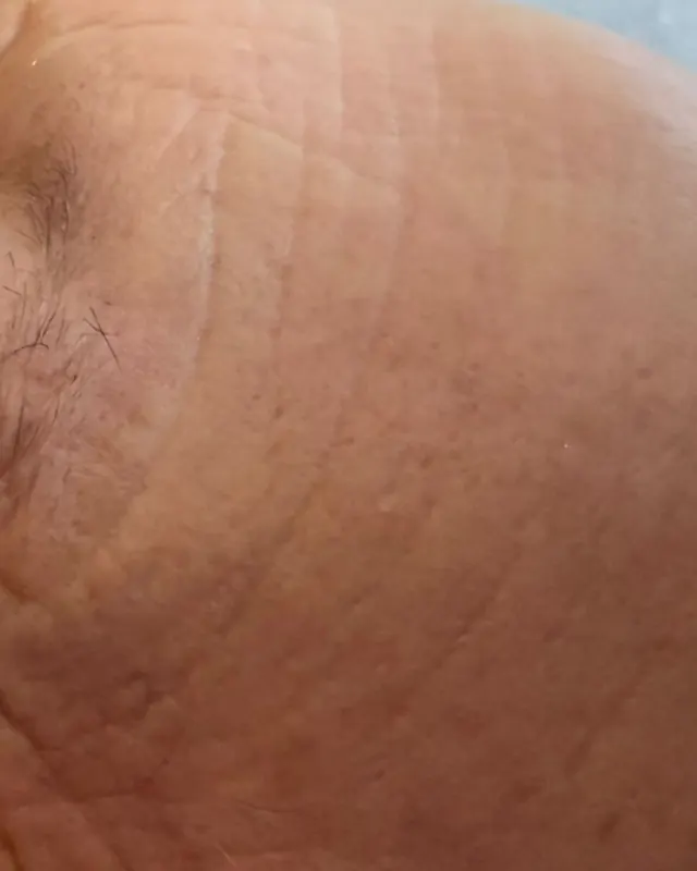 Dopo: Rughe del contorno occhi